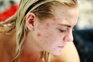 perioralni dermatitis