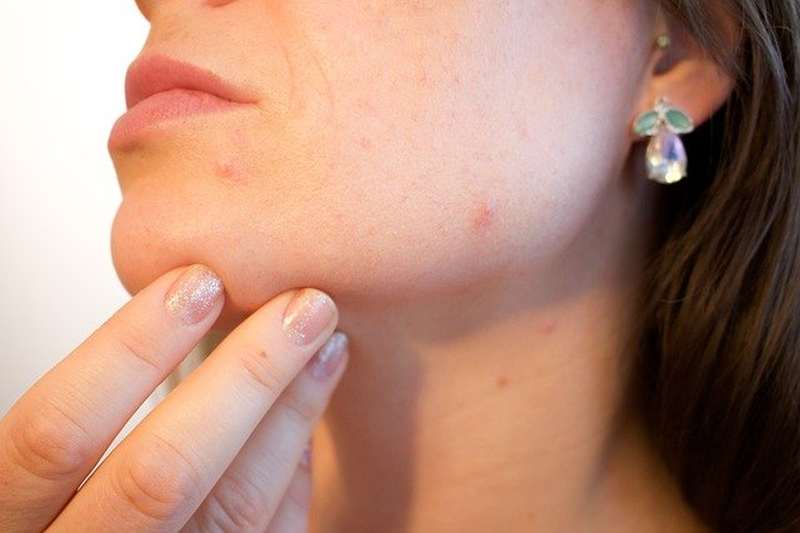 Perioralni dermatitis: vzroki, simptomi in zdravljenje